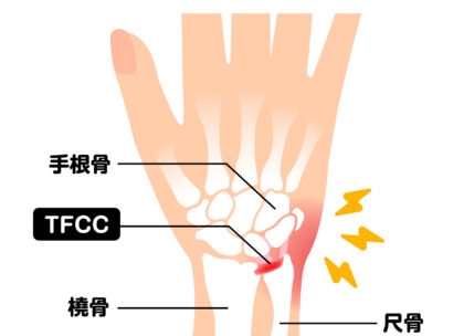 TFCC損傷