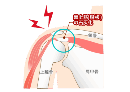 肩の疾患