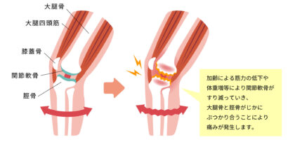変形性膝関節症