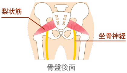 坐骨神経痛