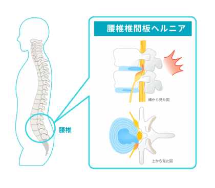 腰椎椎間板ヘルニア
