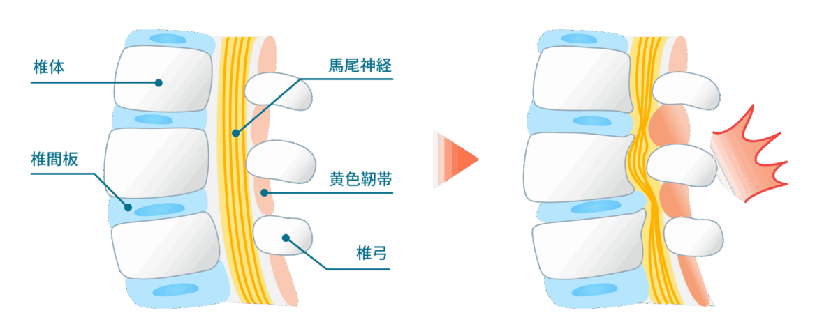 腰部脊柱管狭窄症