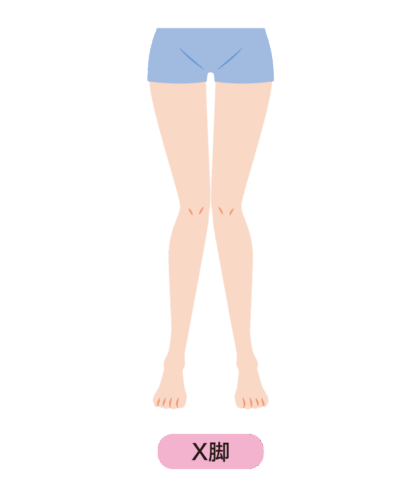 X脚