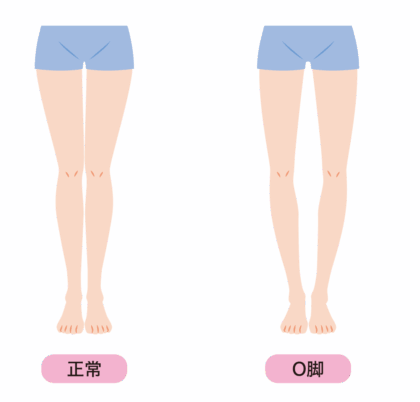 O脚